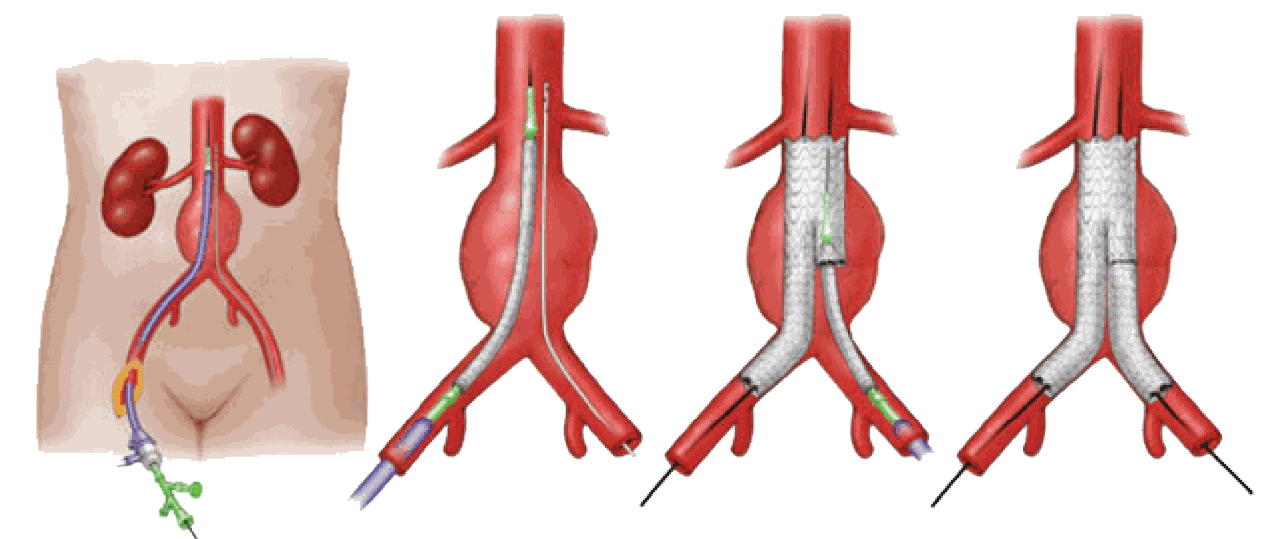 Sequência do tratamento de aneurisma da aorta abdominal com endoprótese
