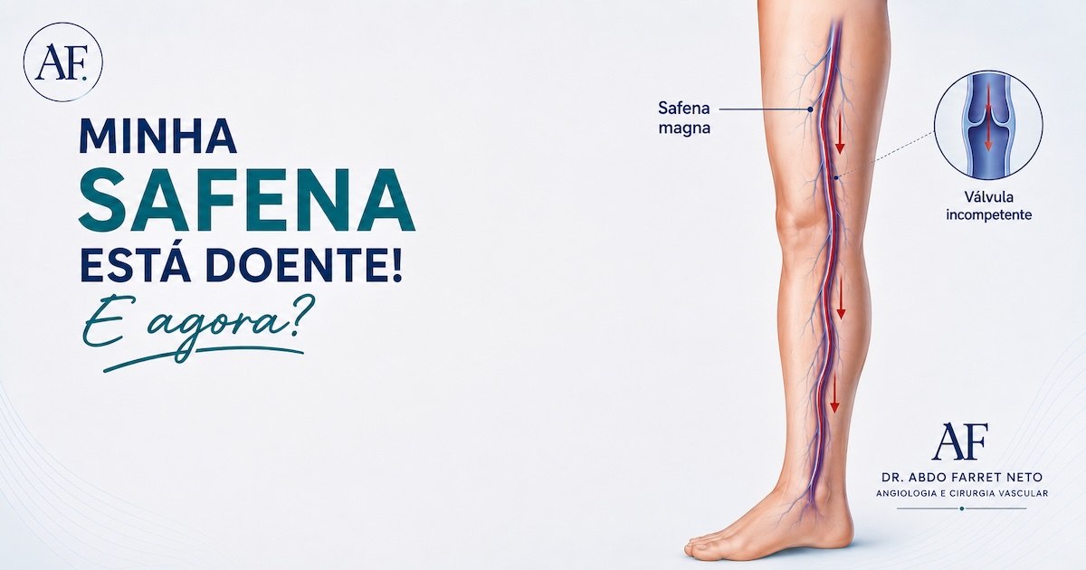 Ilustração da veia safena magna com válvula incompetente, sob o título Minha safena está doente! E agora?