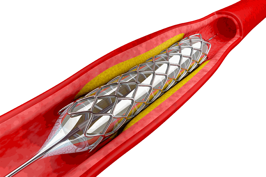 Stent expansível por balão sendo aberto sobre a placa