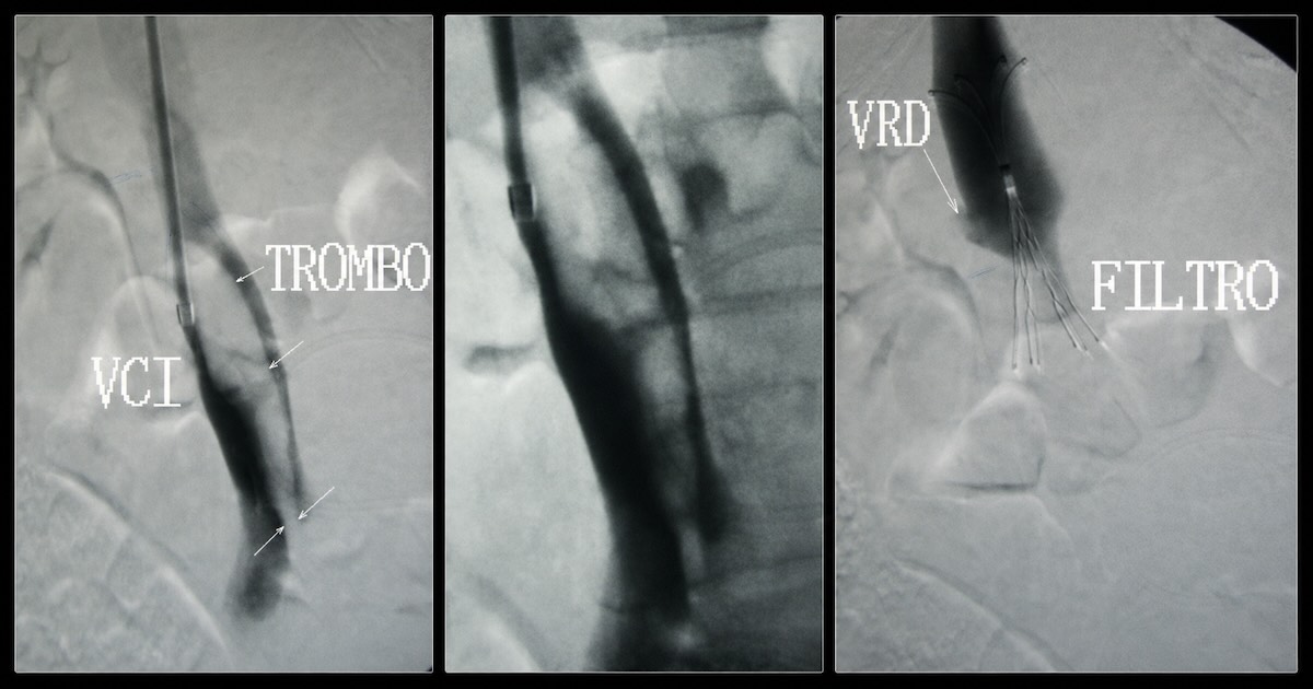 Três angiografias do caso lado a lado: o trombo flutuante na veia cava inferior, a cava contrastada e o filtro já aberto abaixo da veia renal direita