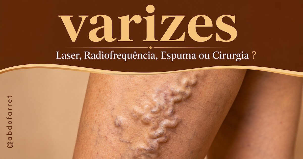Perna com varizes calibrosas em destaque, sob o título Varizes: laser, radiofrequência, espuma ou cirurgia?