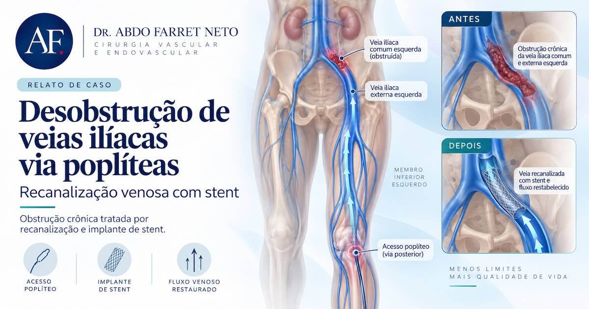 Ilustração do sistema venoso da pelve e da perna esquerda com a veia ilíaca obstruída, e dois detalhes de antes e depois mostrando a veia recanalizada com stent