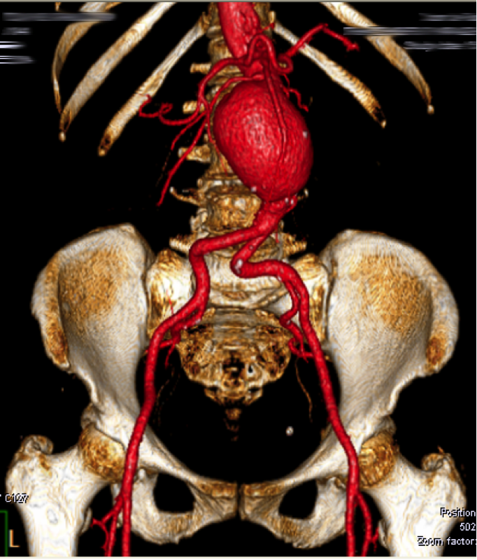 Aneurisma da Aorta Abdominal