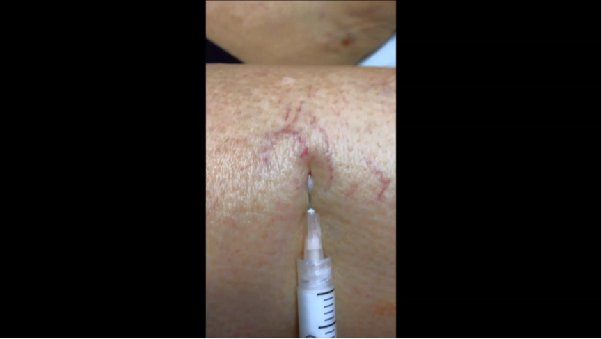 Escleroterapia com espuma